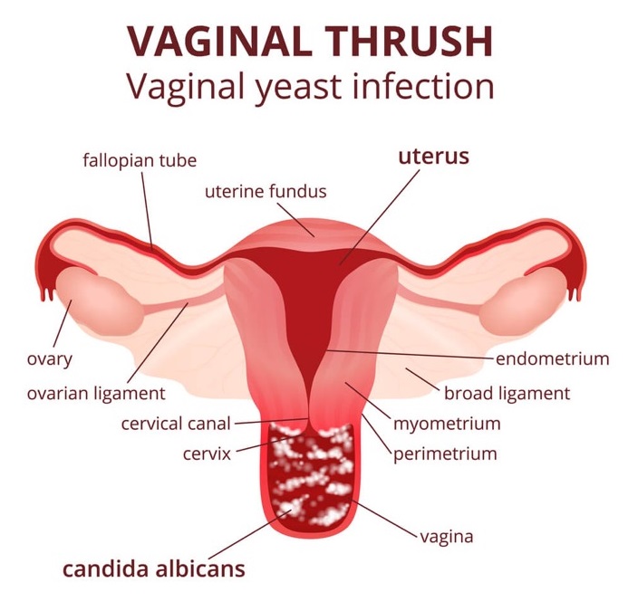 Vaginal Thrush - Vaginal Yeast Infection
