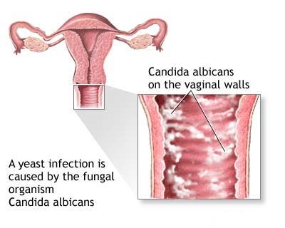 vaginal yeast infection causes